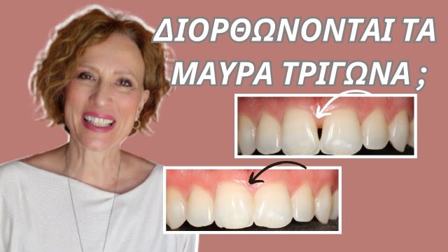  μαύρα τρίγωνα στα δόντια