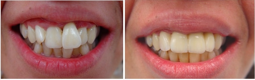 Prosthetic and esthetic treatment in perio patient