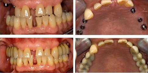 Screw-retained implant prosthesis in perio patient