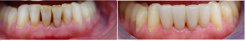 Porcelain veneers in perio patient