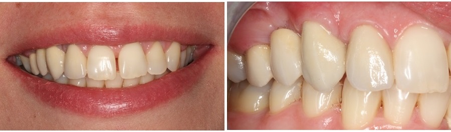 Prosthetic treatment in perio patient