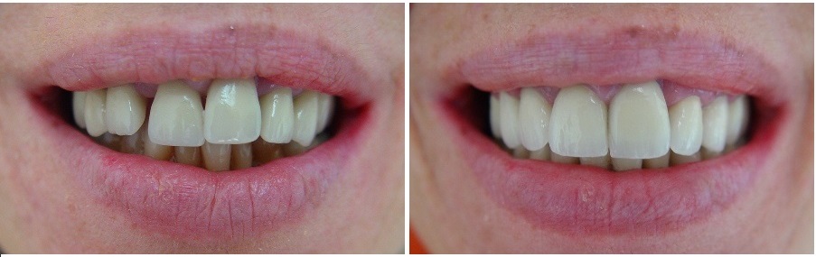 Prosthetic and esthetic treatment in periodontal patient