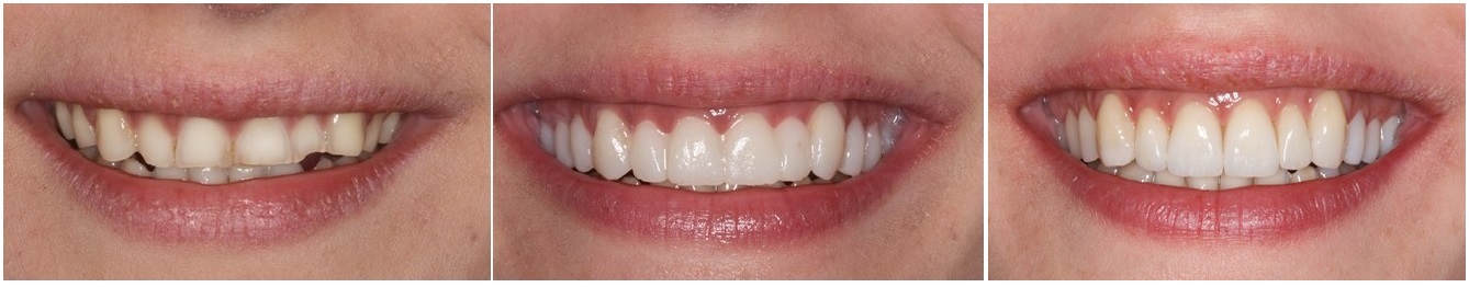 sixveneers