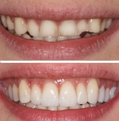 veneersbefore after2